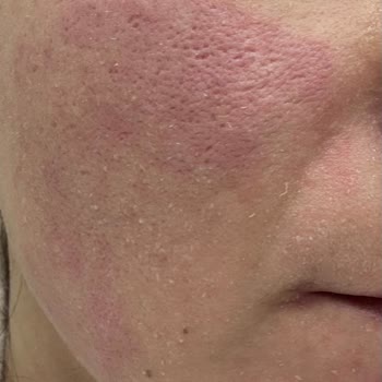 Doğum Günümde Hayal Kırıklığı: Cilt Bakımı Kabusu