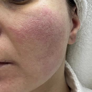 Doğum Günümde Hayal Kırıklığı: Cilt Bakımı Kabusu