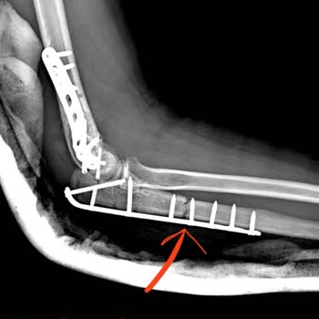 Fizik Tedavi Skandalı: Sağlam Dirsek Kemiği Kırıldı!