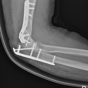 Fizik Tedavi Skandalı: Sağlam Dirsek Kemiği Kırıldı!