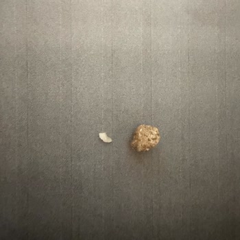 Çerezya Çıtır Leblebi'de Taş Çıktı: Dişim Kırıldı!