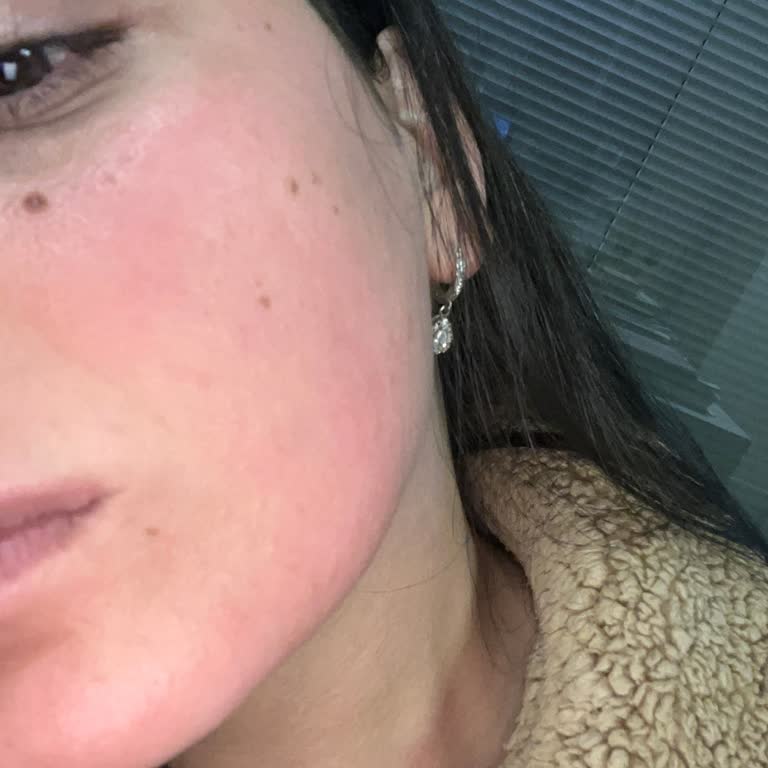 Beklenmedik Alerjik Reaksiyon: Estee Lauder Ürünleri