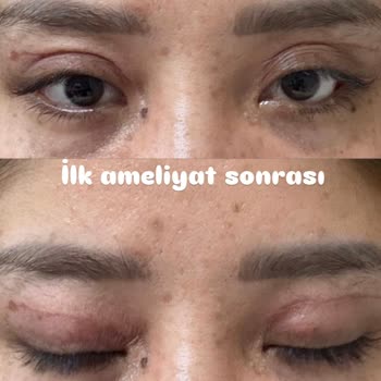 Yanlış Ameliyat Sonrası Mağduriyet