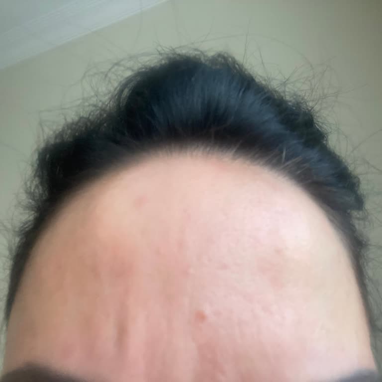 Güneş Kremi Kızarıklık Sorunu