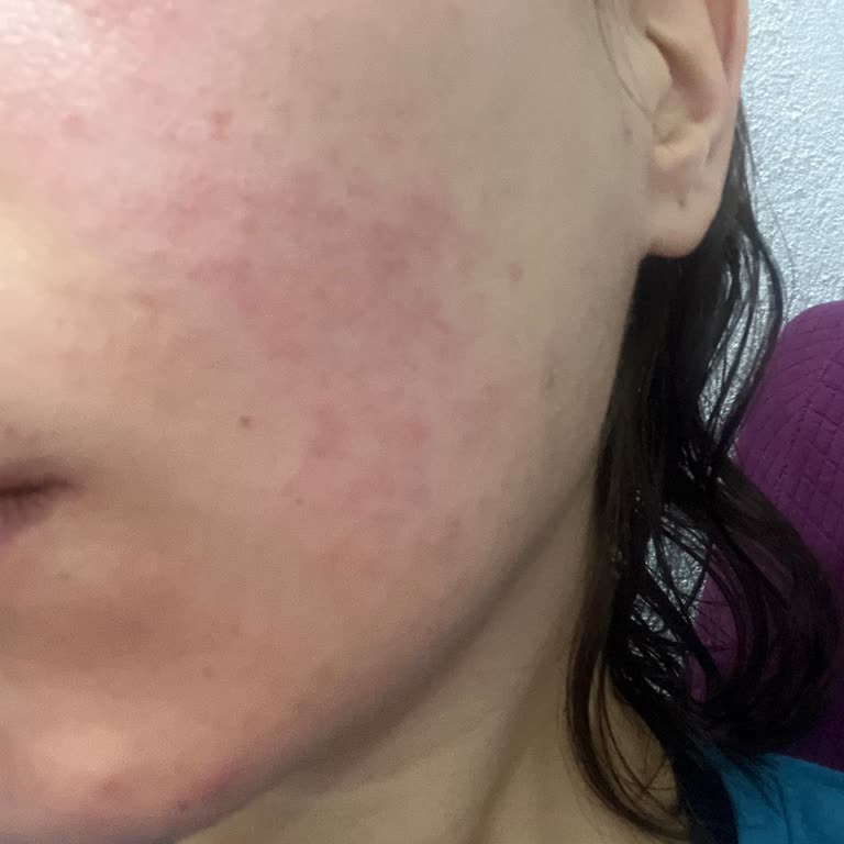 Alerji Yapan Yüz Toniği Sorunu