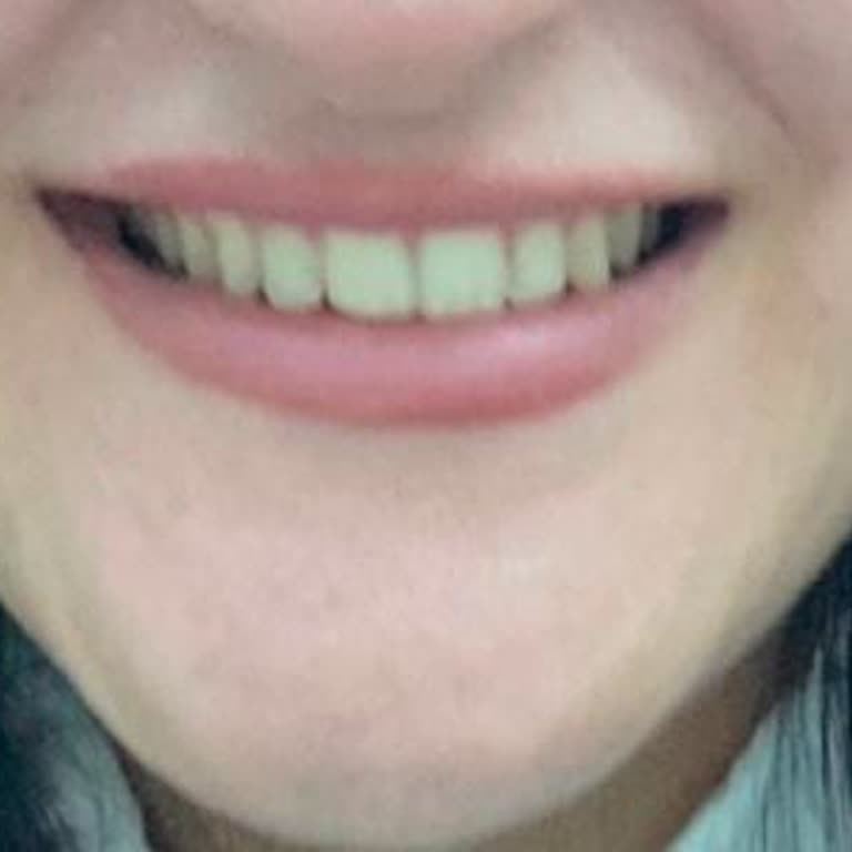 Tel Tedavisi Sonrası Hayal Kırıklığı