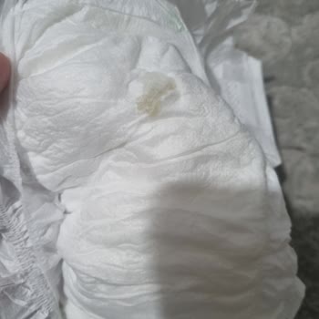 Bebek Bezinde Sağlık Tehdidi: Jelimsi Madde Şoku