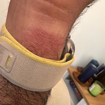 Zore Aksesuar Orijinal Apple Watch Kordonunda Alerjik Reaksiyon!