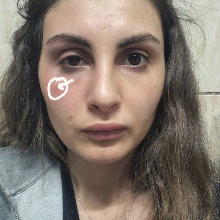 Estpoint Estetik Kliniği Şikayeti