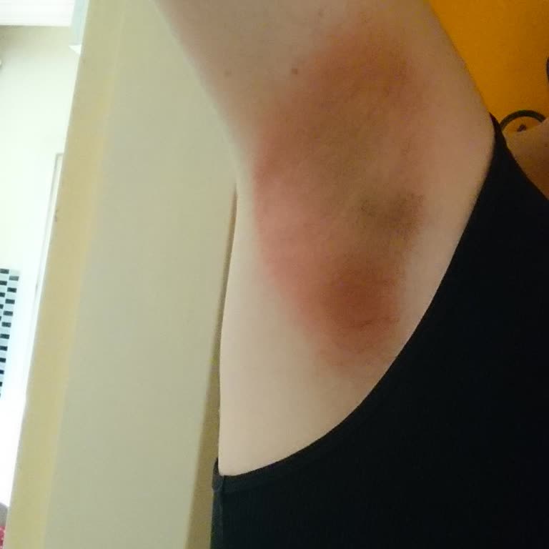 Doğal Roll-On Kullanımı Sonrası Ciddi Alerjik Reaksiyon