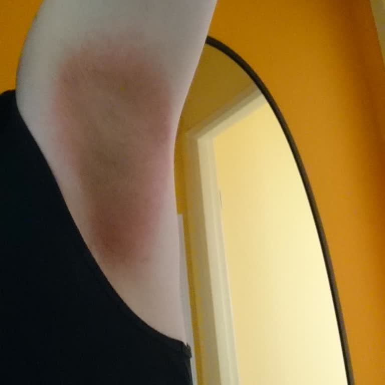 Doğal Roll-On Kullanımı Sonrası Ciddi Alerjik Reaksiyon