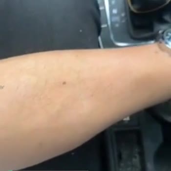 Mersin Esse Life Pozcu Şubesi Kolumu Yaktı Ve İlgilenmediler!