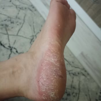 Sağlık Sorunlarına Yol Açan Ayak Maskesi