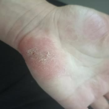 Sağlık Sorunlarına Yol Açan Ayak Maskesi