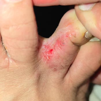 Sağlık Sorunlarına Yol Açan Ayak Maskesi