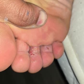 Sağlık Sorunlarına Yol Açan Ayak Maskesi