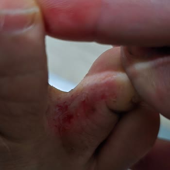 Sağlık Sorunlarına Yol Açan Ayak Maskesi