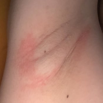 Yves Rocher Hassas Cilt Kabusu: Deodorantın Yol Açtığı Sorunlar