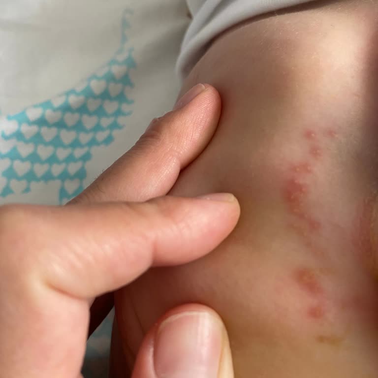 Molfix Külot Bez Kalitesizliği: Bebeğimde Ciddi Pişik Sorunu