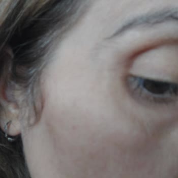 Göz Çevresi Kremi Şişlik Ve Kızarıklık Yaptı