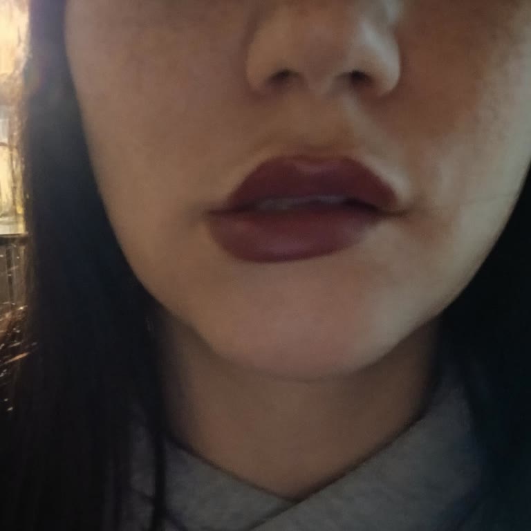 Miami Beauty Studio Dolgu Sonrası Hayal Kırıklığı Ve İletişim Sorunları!