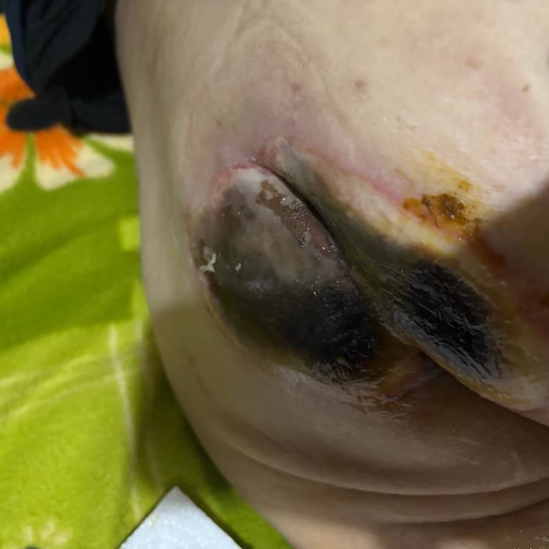 Hastanede Yoğun Bakımda Yetersiz İlgi Ve Taburcu Süreci