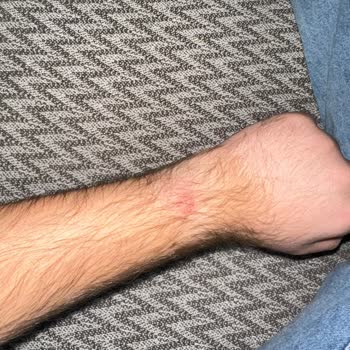 Apple Watch Ultra'da Beklenmedik Cilt Problemi