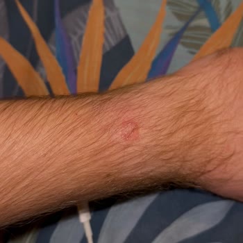 Apple Watch Ultra'da Beklenmedik Cilt Problemi