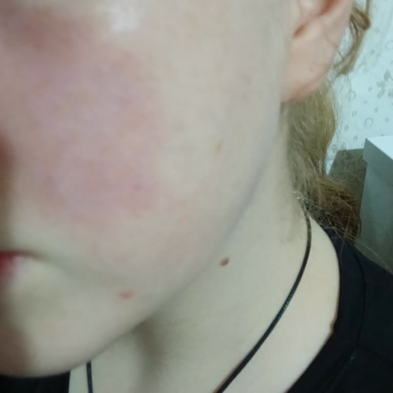 Claderm Kil Maskesi Sonrası Cilt Reaksiyonu