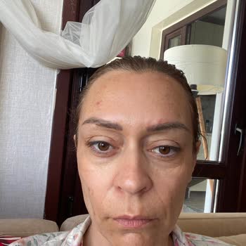 Yves Rocher Krem Sonrası Ciltte Yaralar Ve Sivilceler