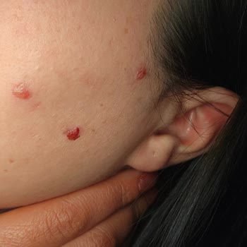 Peeling Serumu Sonrası Yüzümde Beklenmedik Şişlikler Ve İltihap