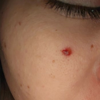 Peeling Serumu Sonrası Yüzümde Beklenmedik Şişlikler Ve İltihap