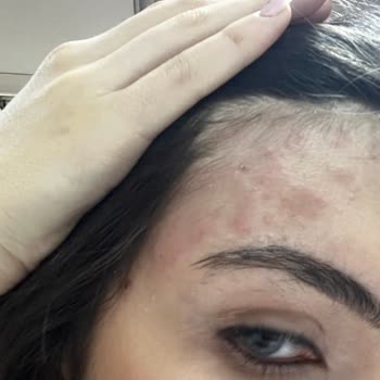 Alerji Yapan Saç Ürünü