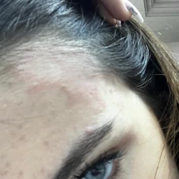 Alerji Yapan Saç Ürünü