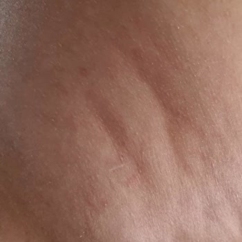 Liposuction Sonrası Yaşanan Hayal Kırıklığı: Özensiz İşlem Ve Kalıcı Hasar