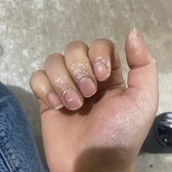 Sağlık Tehdidi: Leke Çıkarıcı Ellerimi Yaktı!