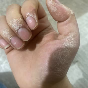 Sağlık Tehdidi: Leke Çıkarıcı Ellerimi Yaktı!