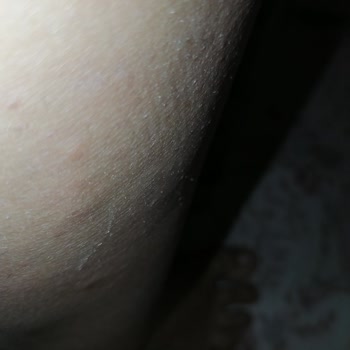 Uyuz Sorunu Ve Psikolojik Yıpranma