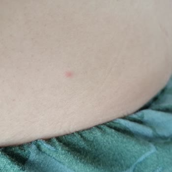 Uyuz Sorunu Ve Psikolojik Yıpranma