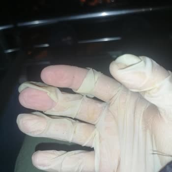 Uyuz Sorunu Ve Psikolojik Yıpranma