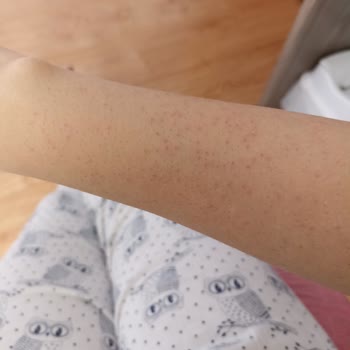 Yanma Ve İz Yapan Tüy Dökücü Krem Sorunu