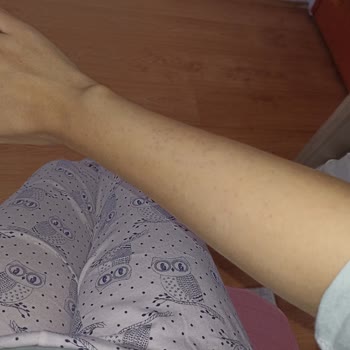 Yanma Ve İz Yapan Tüy Dökücü Krem Sorunu