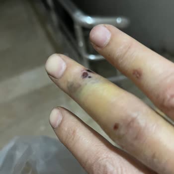 Hastanede İlgisizlik Ve Bekleyiş: Kırık Parmakla Mücadele