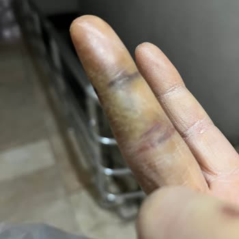 Hastanede İlgisizlik Ve Bekleyiş: Kırık Parmakla Mücadele