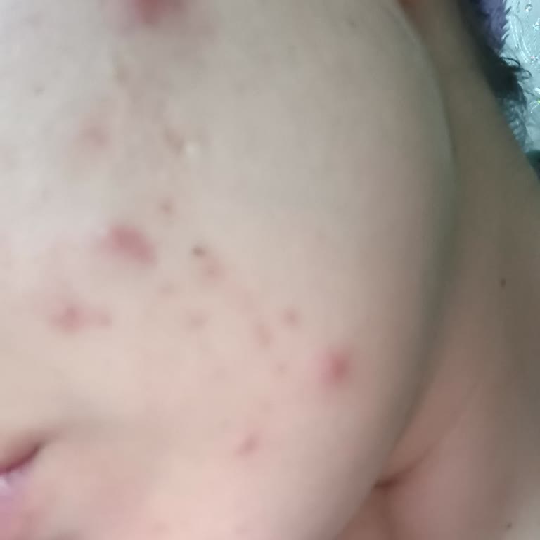 La Roche Posay Effaclar Duo+M İle Artan Sivilce Sorunu