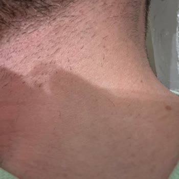 Lazer Epilasyon Sonuçsuz Kaldı