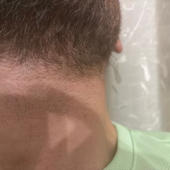 Lazer Epilasyon Sonuçsuz Kaldı