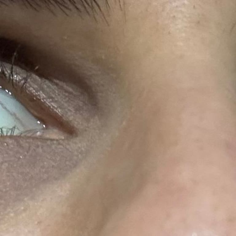 Estetik Operasyon Felaketi: Düzeltilemeyen Hatalar