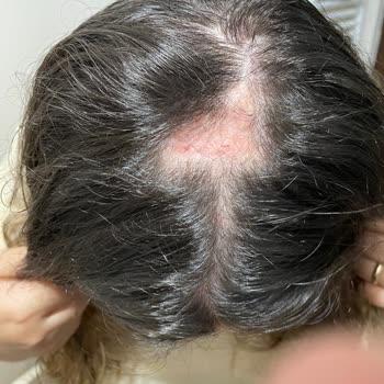 Hair Black (İbrahim Güneş) Kuaförde Yaşanan Kabus: Sağlık Sorunları ve Mağduriyet