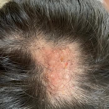 Hair Black (İbrahim Güneş) Kuaförde Yaşanan Kabus: Sağlık Sorunları ve Mağduriyet